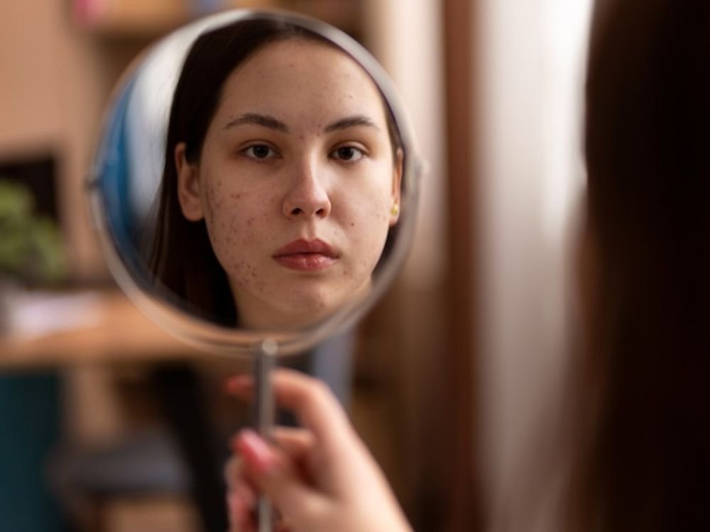 Pele Acneica: Cuidados com a pele do rosto! jovem se olhando no espelho com acne no rosto.