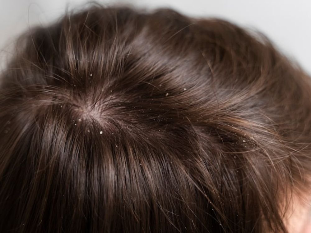 melhor shampoo anticaspa: shampoo anticaspa feminino 