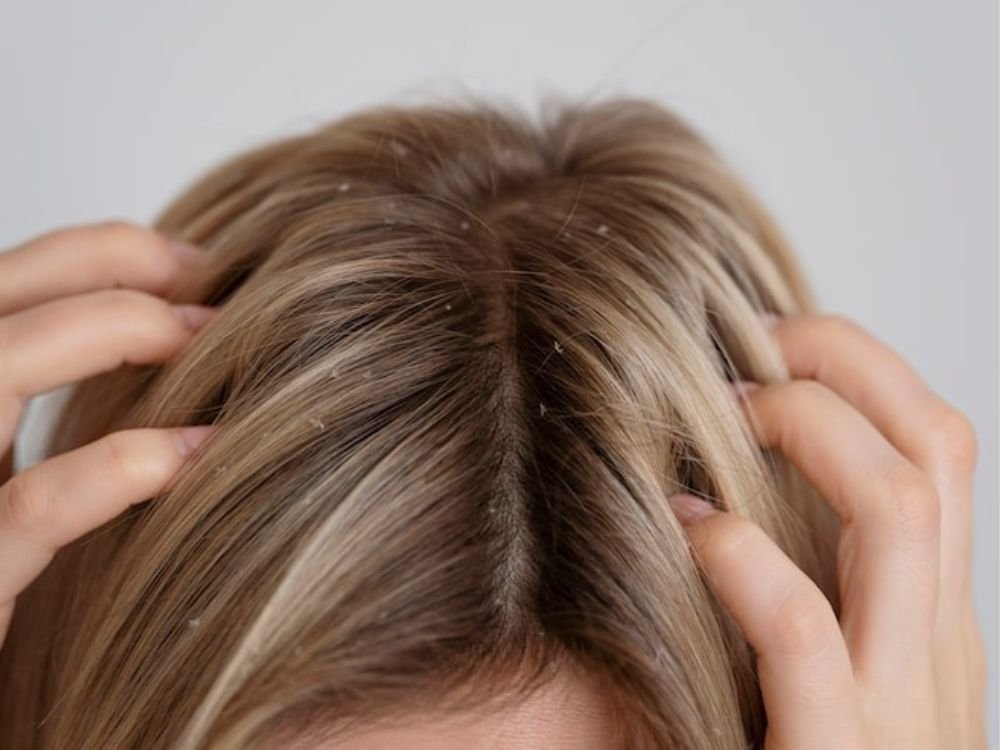 melhor shampoo anticaspa: shampoo anticaspa feminino 